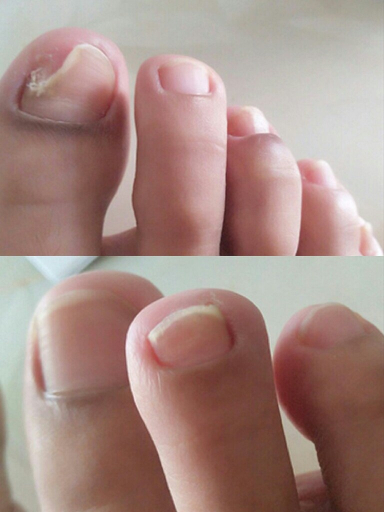 神笔灰甲灰指甲专用抑菌液非治疗药软甲脱甲膏冰醋酸脚趾正品官网